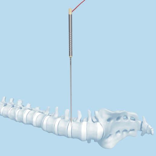 Durch Stimulation mit der monopolaren Sonde einen sicheren Zugang durch den M. psoas zur Lendenwirbelsäule bestimmen.