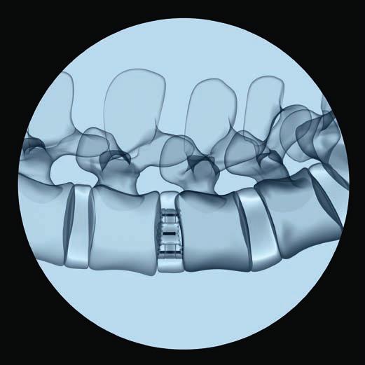 Operationstechnik Bei ordnungsgemässem Sitz des Implantats sind die beiden medial/lateral eingebetteten Röntgenmarker in lateraler Ansicht als ein einziger Röntgenmarker sichtbar.