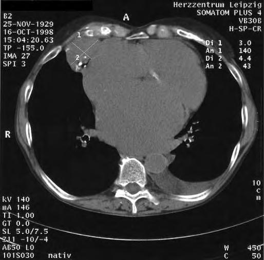 Solitary fibrous tumor of the pleura CT scan revealed a tumor 4 cm in