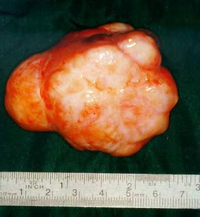 Solitary fibrous tumor of the pleura The right pleural cavitiy was opened.. A 4 x 6 cm tumorous mass was found.