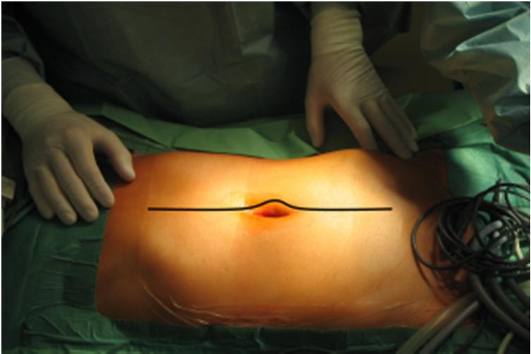 Bei der Operation wird: Der Bauch wird über einen Längsschnitt vom Schambein bis zum Brustbein eröffnet (