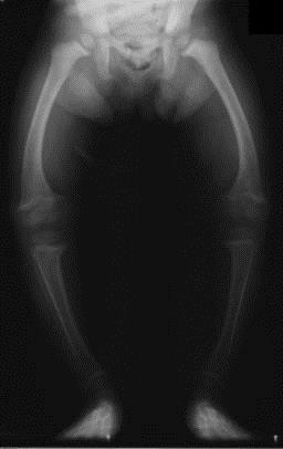 Mangel Mangel an Calcium und Phosphat Osteomalazie ( Knochenerweichung ) Rachitis (Kinder) fehlende Mineralisation des Knochens Folgen: Knochenschmerzen Knochenverformungen Osteopenie bzw.