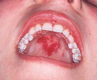 Haarausfall 4. Wunden in Mund / Nase 5. Gelenksentzündung 6.