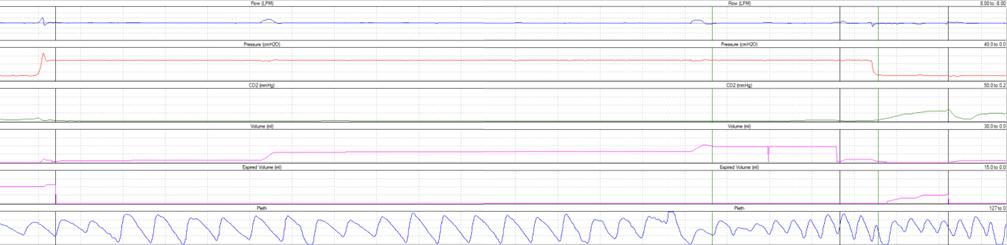 etco2 (grün), Vti (violett), Vte (violett) und Plethysmographie