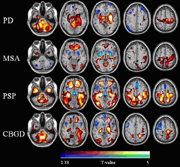 FDG-PET des Gehirns bei Parkinson: Mustererkennung Neuroimage 2005; 6: 371-388 IPS