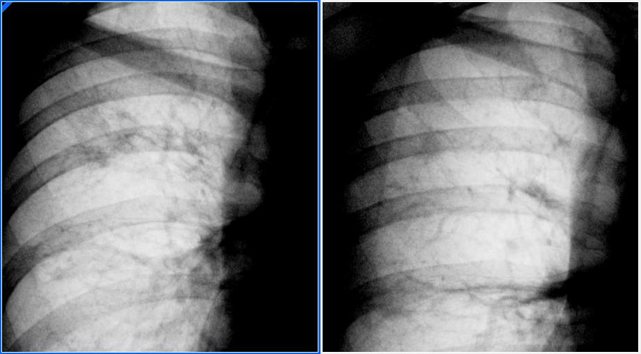 Der Weg zur XD-TB 1/2015: eaktivierung Therapie mit Delamanid 200mg/d, Moxifloxacin, Capreomycin, Linezolid