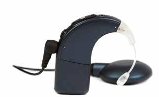 Wenn der Schaden aber größer ist, reicht es nicht aus, die Klänge einfach nur lauter zu machen. 2 Cochlea-Implantate sind die standardmäßige Behandlungsoption für Menschen mit hochgradigem Hörverlust.
