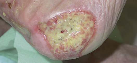 Beispiele für Anwendungsgebiete Dekubitus an Ferse infiziertes