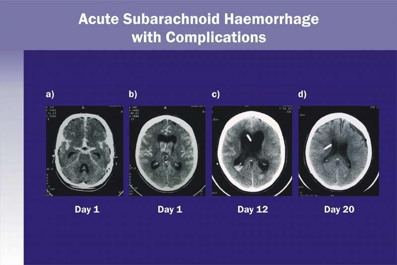 Subarachnoidalblutung mit