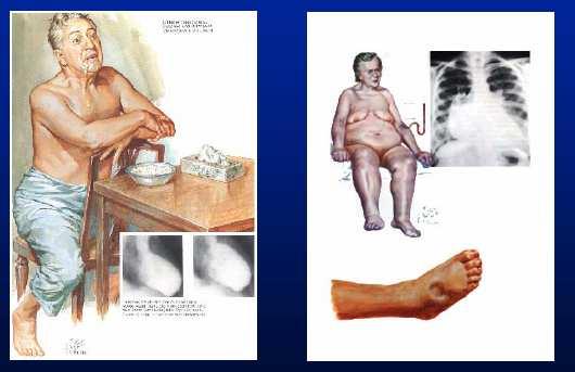 Chronic Congestive Heart