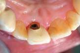 Unter Lokalanästhesie wurde der Zahn entfernt, wobei mit einem Periotom vorsichtig das Ligamentum circulare gelöst wurde. Der Zahn war seit ca.
