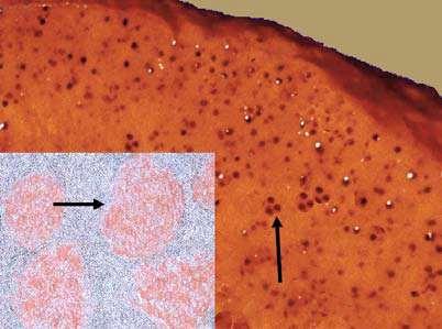 ZELLSCHADEN AMYLOIDOSE Makroskopie Makroskopisch zeigen von der Amyloidose stärker betroffenen Organen eine grau-weisse, speckige Färbung und eine