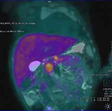 Befund In der 18 F-DOPA-PET/MR findet sich im Bereich des Pankreaskorpus eine noduläre exophytische Raumforderung nach ventral und kranial im Sinn einer fokalen Form des