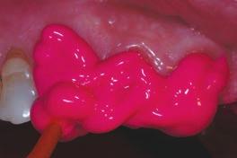 Hydrophilie Hydrorise ist bereits im unabgebundenen Zustand extrem feuchtigkeitsverträglich und ermöglicht so beste Abformergebnisse auch unter schwierigen Bedingungen in der Mundhöhle durch Blut-