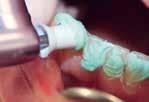 Tabakbeläge) Politur von Zahnoberflächen im Rahmen einer professionellen Zahnreinigung, vor dem Bleichen und nach dem Entfernen von KFO-Geräten Reinigung und Politur von Füllungen im Rahmen einer