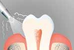 handlung überempfindlicher Zahnhälse Be