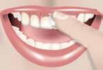 Nach dem Bleaching Nach der professionellen Zahnreinigung Vorbeugung und Kontrolle von Hypersensibilitäten Während einer kieferorthopädischen Behandlung