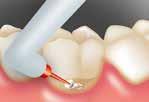 Die Anwendung von Admira Protect empfiehlt sich auch bei freiliegenden Kronenrändern, nach Zahnreinigungen oder Zahnsteinentfernungen.