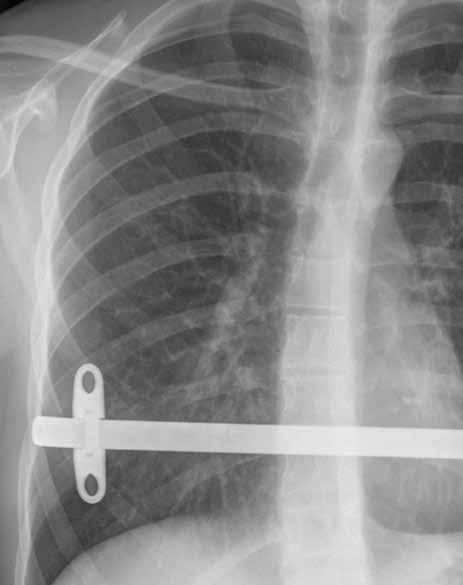Röntgenseit- und Röntgenfrontaufnahme eines Patienten nach minimal-invasiver Trichterbrustkorrektur. Der eingebrachte Metallbügel hält das Brustbein in der korrigierten Position. gehalten.