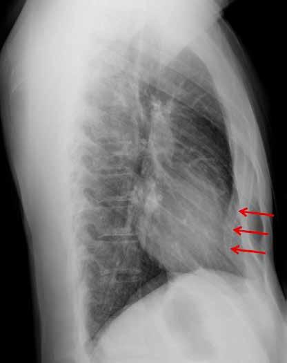 Röntgenseitaufnahme eines Patienten mit Trichterbrust. Die roten Pfeile zeigen die Position des unteren Brustbeins, welches auffällig nach innen verlagert ist. Was ist eine Trichterbrust?