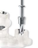 Implantatchirurgie Guided Surgery Sleeve-on-Drill Bohrhülsen Die Sleeve-on-Drill Bohrhülsen dienen der sicheren Führung der Bohrer in der Bohrschablone.