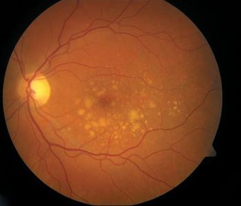 Einschränkungen des Sehvermögens große negative Auswirkungen auf die Lebensqualität und die Lebensdauer eines Patienten haben A (Abbildung 1) (A) Unauffällige Makula (B) Drusen B Retina Behinderung