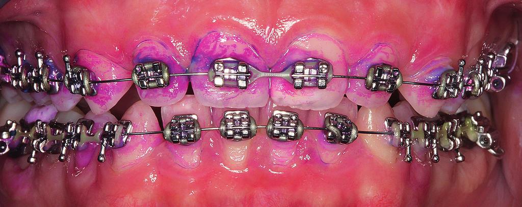 FACHBEITRAG Schöne Zähne prägen erheblich das äußere Erscheinungsbild. Nicht immer sind diese von der Natur gegeben, daher muss in manchen Fällen mittels kieferorthopädischer Geräte therapiert werden.