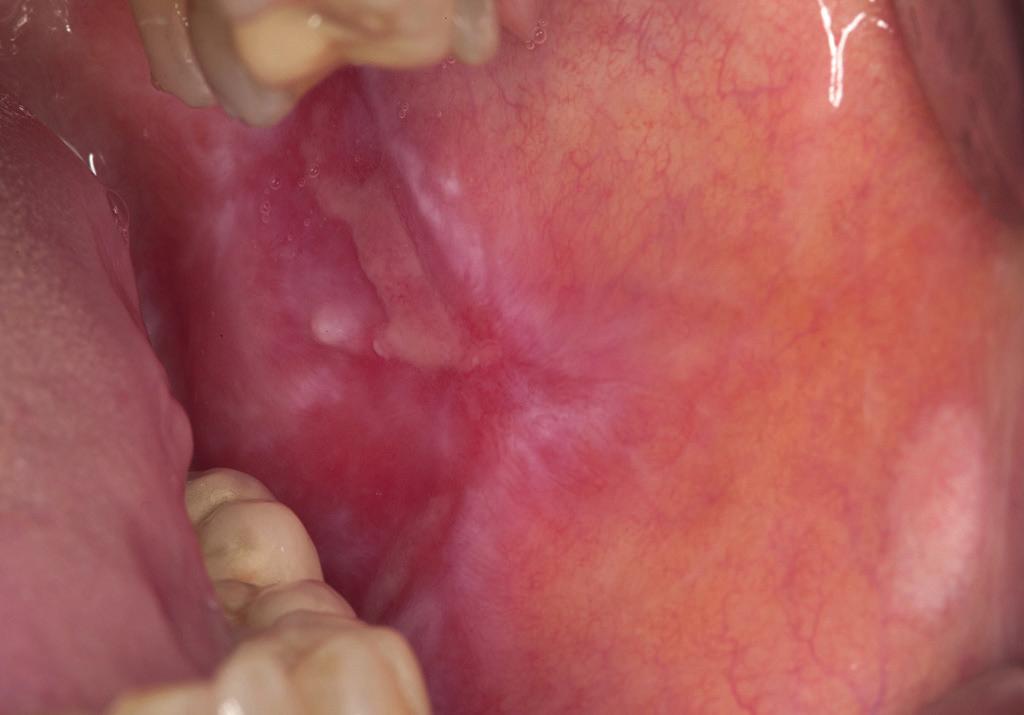 Am extremsten zeigen sich mukosale Miss emp findungen beim Burning Mouth-Syndrom (BMS): Das primäre BMS: eine diagnostische und therapeutische Herausforderung 15,16 ausreichende Flüssigkeitsaufnahme