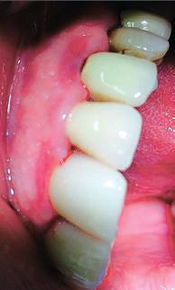 ANWENDERBERICHT Die Parodontitis ist eine bakteriell bedingte Entzündung des Zahnhalteapparates.