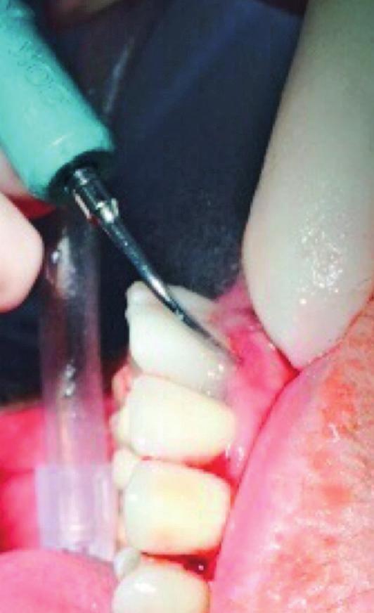 Dies resultiert in einer Zahnlockerung und führt unbehandelt zum Zahnverlust. Narges Q.