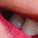 In verschiedenen Zahnarztpraxen wird der PerioChip ohne vorausgegangene Behandlung