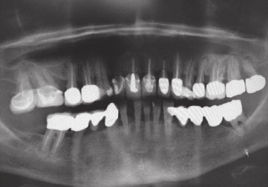 3a: Die Durchführung der Parodontalbehandlung. Abb. 3b: Die Außenansicht der Patientensituation vor und Abb. 3c: nach der Behandlung mit dem PerioChip.