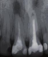 Das Vorgehen stellte sich postoperativ wie folgt dar: Postoperative Röntgenkontrolle (digitaler Zahnfilm). Recall 1: Telefonisch am ersten Tag (+/- 1 Tag post-op), postoperativer Schmerzverlauf.