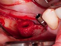 maxgraft bonering wird aus spongiösen Knochenblöcken hergestellt, die aus Femurköpfen von Lebendspendern (Implantation einer Hüft-Totalendoprothese) gewonnen werden.
