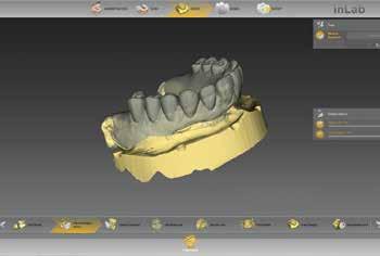 Die inlab CAD Software bezieht dabei Aufstellung und Morphologie der vorhandenen Zähne in ihre Analyse