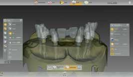 Als Teil der integrierten Implantatplanung mit 3D-Röntgensystemen von Dentsply Sirona bildet die CAD/CAM gefertigte Bohrschablone die ideale Planungsbasis für die