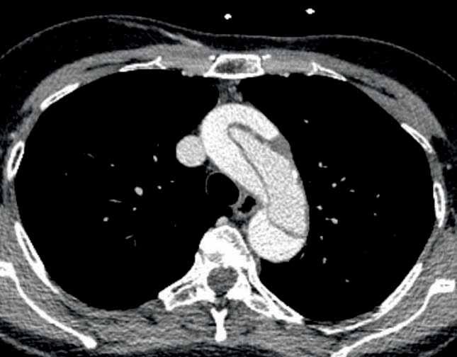 Diagnostik Computertomographie (CT) Die Computertomographie (CT) basiert auf der Nutzung von Röntgenstrahlen und produziert wie die MRT viele Schnittbilder.