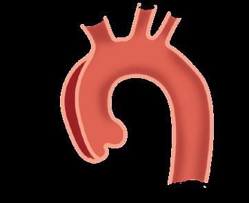 Macht sich ein Bauchaortenaneurysma (abdominelles Aortenaneurysma) durch Rücken-, Bauch- oder Flankenschmerzen bemerkbar, muss