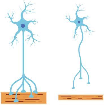 Spinale Muskelatrophie (SM) Motorneuron Deletion des SMN1-Gens (survival motor neuron) defektes RN- Splicing veränderte Proteine