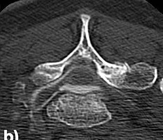 Schleudertrauma Behandlung mittels