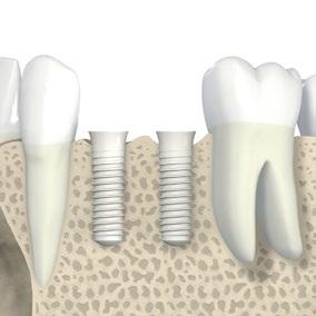 b a D 1 L D₂ D a b c 3 mm 1,5 mm 1,5 mm 1,5 mm 1,5 mm Schulterdurchmesser D [mm] Lückenbreite a min [mm] Abstand zwischen Zähnen auf