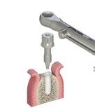 Schritt 2 Korrekte Implantatausrichtung Achten Sie bei der Annäherung an die endgültige Implantatposition darauf, dass die gebohrten Markierungspunkte am Transferteil exakt bukkal/labial ausgerichtet