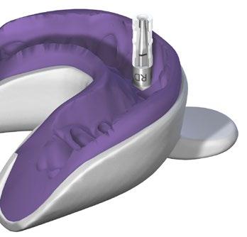 Betten Sie die Hülse mit dem CI RD repositionierbaren Manipulierimplantat in den Dentalhartgips ein.
