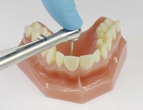 6.9 Eingliederung (in der Zahnarztpraxis) Fixieren Sie die fertiggestellte prothetische Versorgung vor dem Versand an den Zahnarzt im Meistermodell.