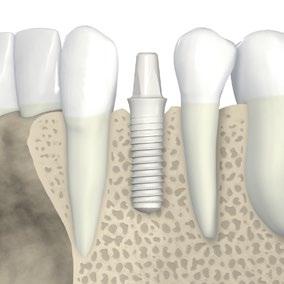 10.1. Implantatposition Bei der Planung der Implantatposition sind die nachstehenden drei Grundregeln zu beachten (siehe auch Straumann Dental Implant System, Basisinformationen (151.754/de)).