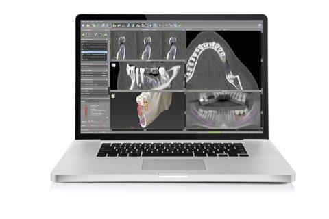 Digitale Behandlungsplanung mit codiagnostix Diese Software für 3D Diagnostik und Implantatplanung wurde für die bildgestützte chirurgische Planung von Dentalimplantaten konzipiert, einschliesslich