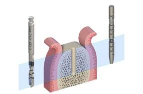 10.2.2 Implantatbettpräparation Nach Öffnung der Gingiva beginnt die Basispräparation des Implantatbetts mit (Schritt 1) der Präparation des Kieferkamms und (Schritt 2) dem Markieren der