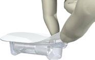 10.4 Setzen des Implantats 1 10.4.1 Öffnen der Implantatverpackung Schritt 1 Öffnen des Blisters und Entnahme des Implantatträgers Hinweis: Der Blister gewährleistet die Sterilität des Implantats.