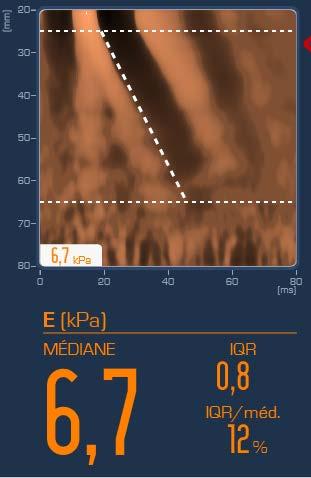 Nicht invasive Fibrosediagnostik Ultraschall-basierte Messung der