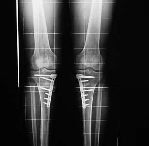 16. September 2008 Kniegelenksnahe Osteotomien